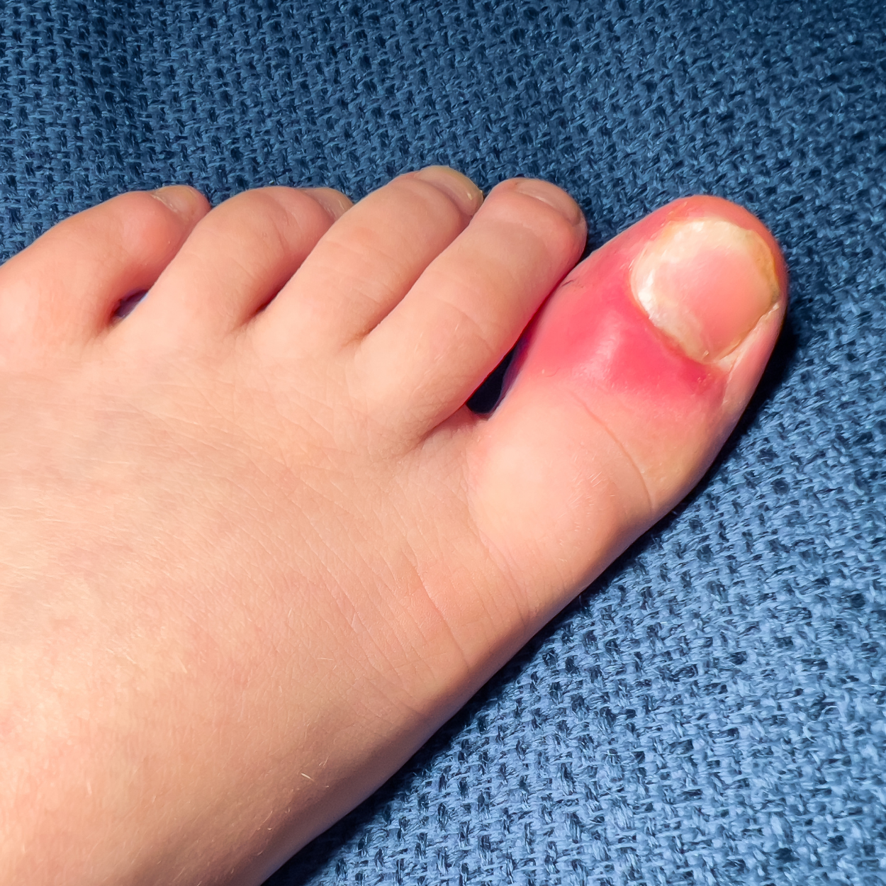 Ícone Espiculaectomia